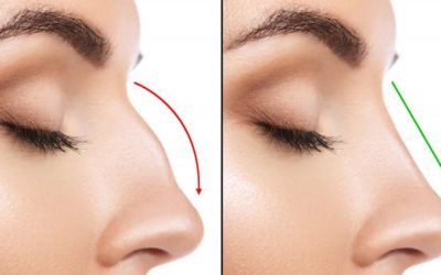 Rhinoplasty: It’s More Than Just a Nose Job, It’s a Game-Changer