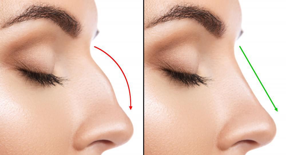 Rhinoplasty: It’s More Than Just a Nose Job, It’s a Game-Changer