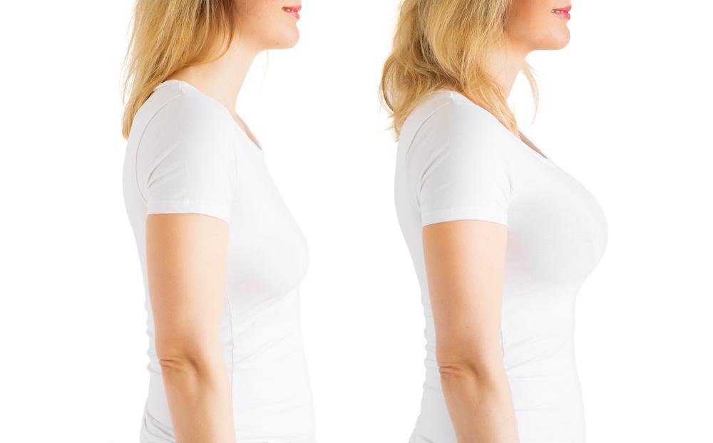 Considering Breast Augmentation? Here’s What You Need to Know