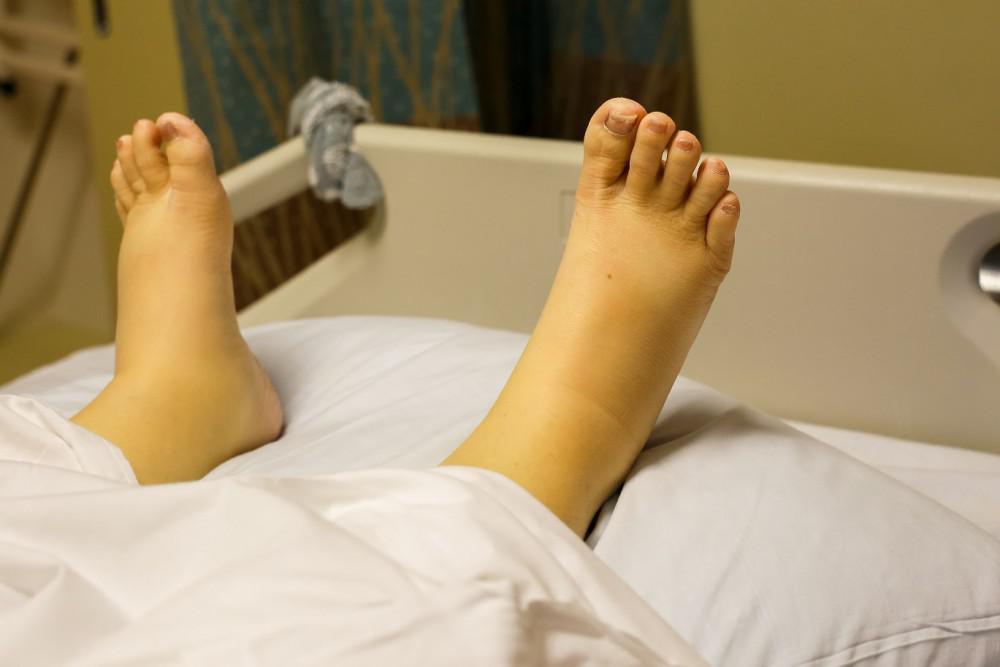 What Are Cankles?
