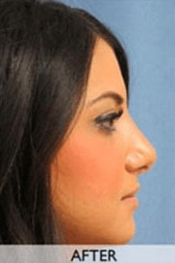 After Nose Surgery Orange County After Nose Surgery Orange County
