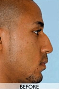 Before Nose Job Orange County Before Nose Job Orange County