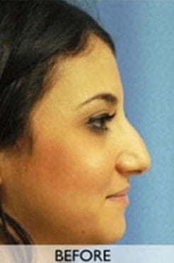 Before Nose Surgery Orange County