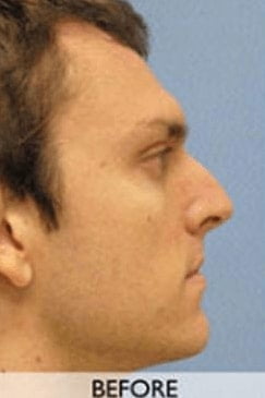 Before Rhinoplasty Orange County Before Rhinoplasty Orange County