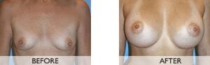 Breast Augmentation California