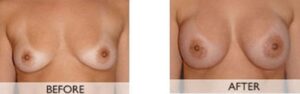 Breast Enlargement Orange County