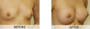 Breast Enhancement Orange County