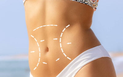 A client confident to the result of his tummy tuck in Newport Beach, CA at Dr. George Brennan Clinic