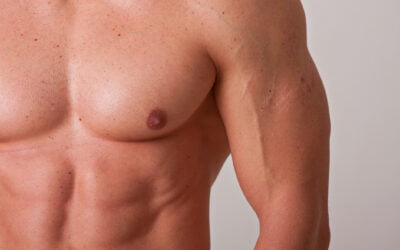 Gynecomastia Newport Beach