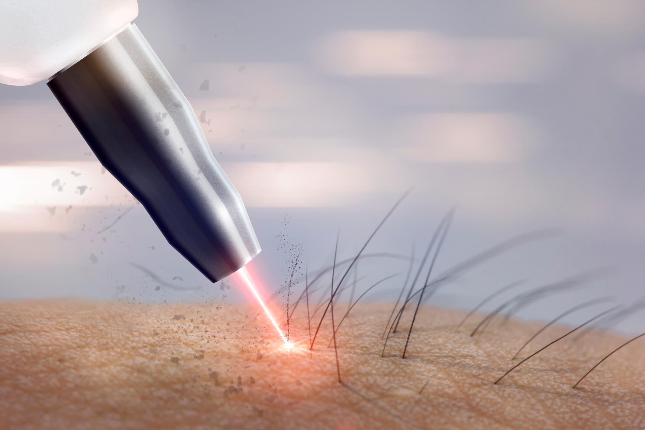 What_Is_Considered_A_Small_Area_For_Laser_Hair_Removal What_Is_Considered_A_Small_Area_For_Laser_Hair_Removal