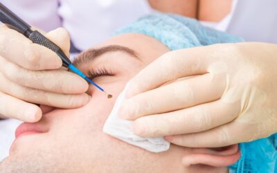 How to Prevent Scarring After Mole Removal