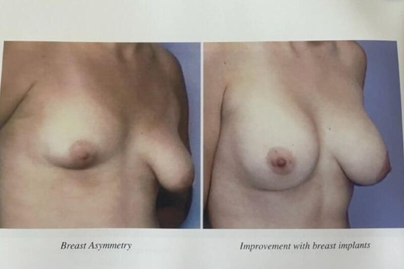 Breast Augmentation in Newport Beach California