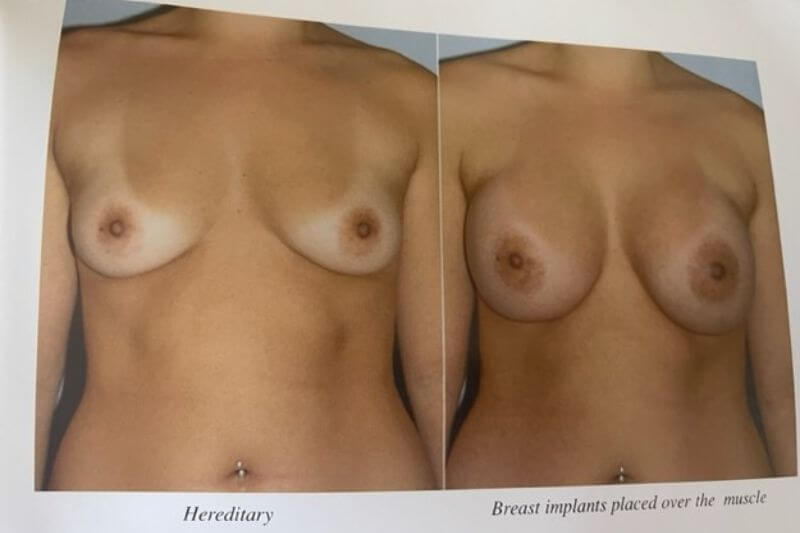 Breast Augmentation in Newport Beach