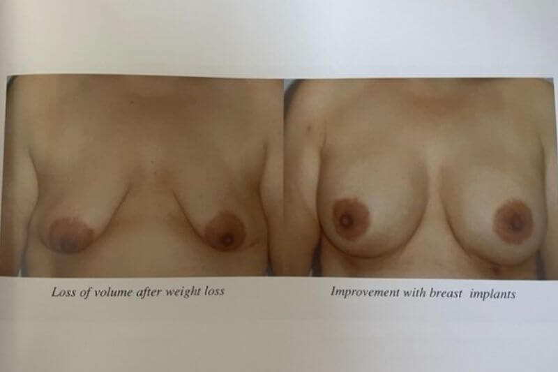 Breast Implants in Newport Beach