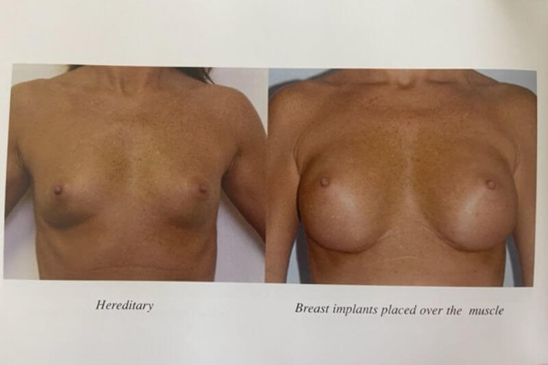 Newport Beach Breast Augmentation