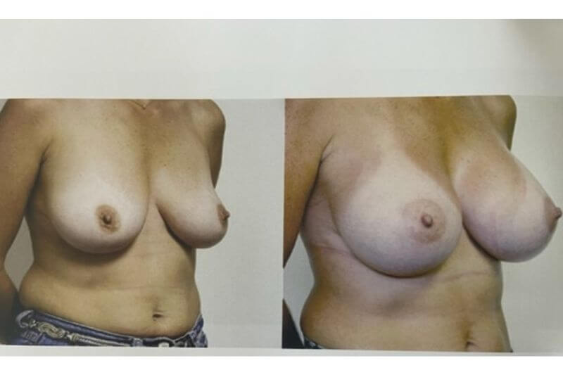 Newport Beach Breast Implants