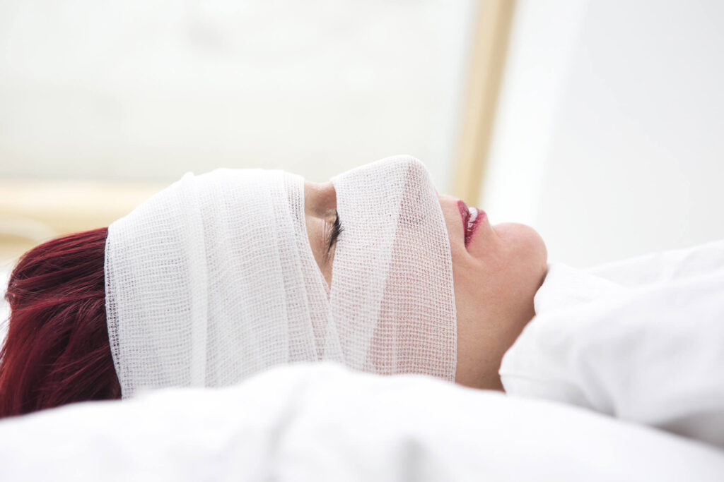 Post-surgery facelift recovery shown under the care of Dr. George Brennan in Orange County California highlighting reduced swelling and improved facial contours