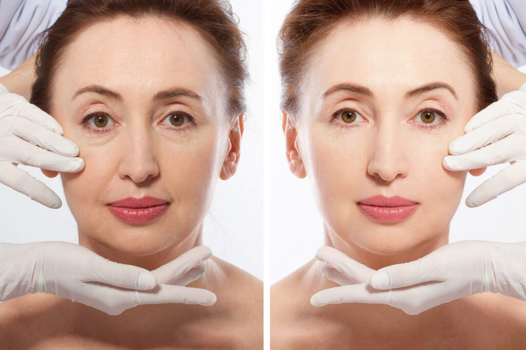 Illustration showing different facelift techniques available from Dr. George Brennan, a plastic surgeon located in Orange County California